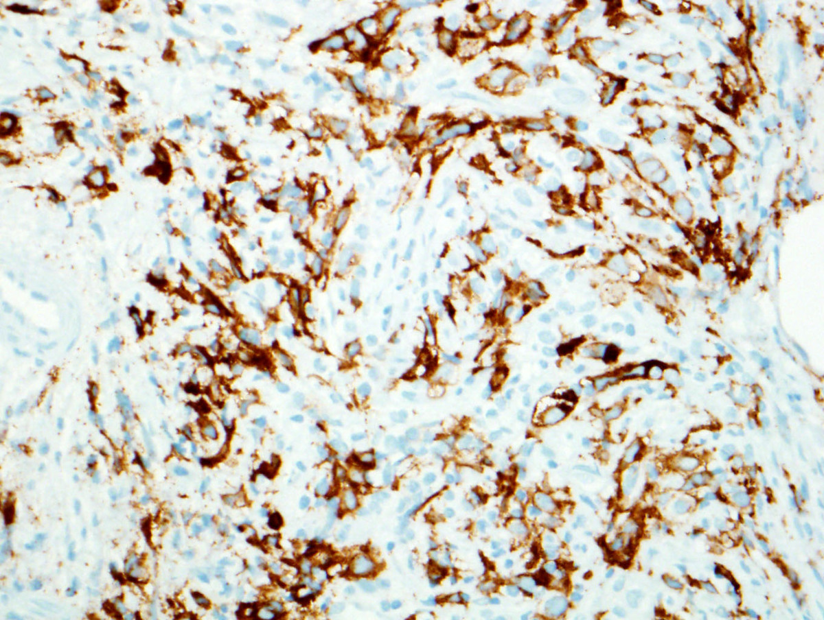 Fig. 5 The blasts were positive for CD61.